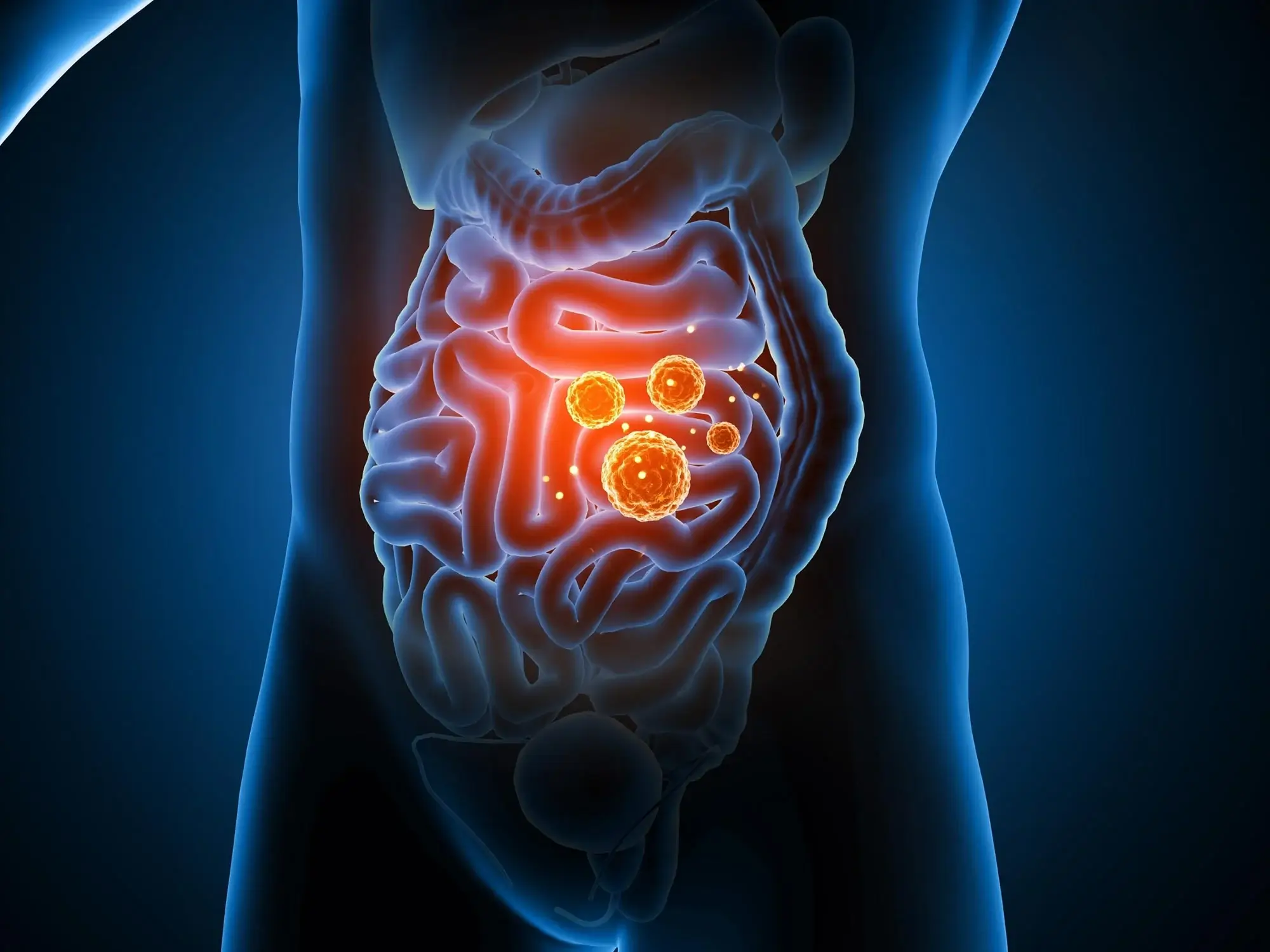What Is a Leaky Gut?