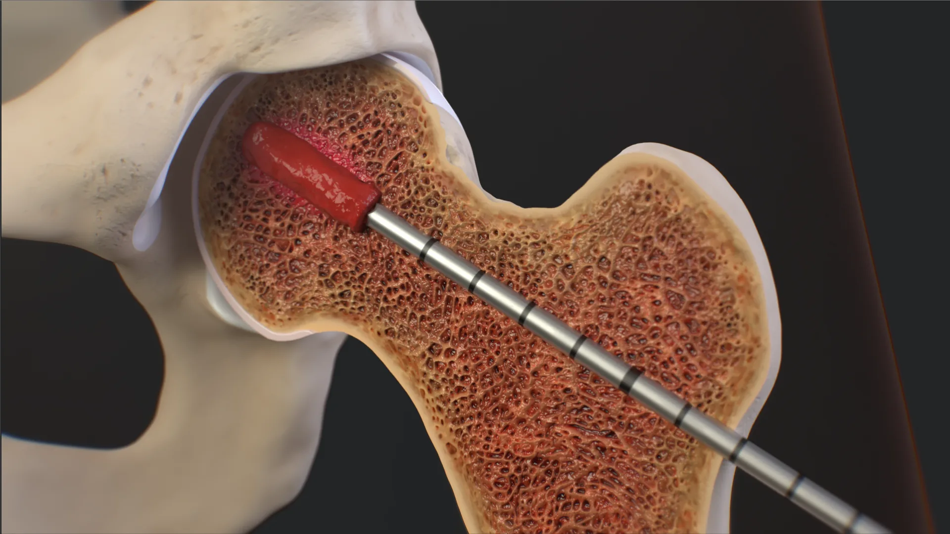 What Does Bone Marrow Look Like